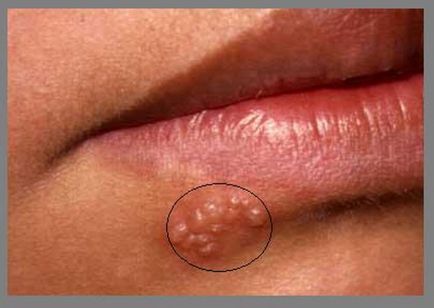 Herpes - tipuri, simptome, tratament