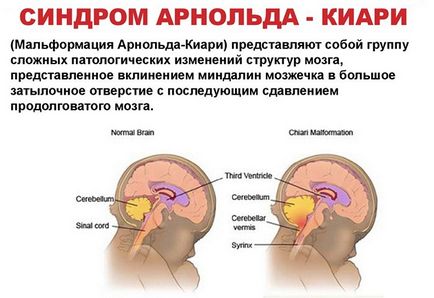 Hidrocefalul creierului la copii sub 1 an (nou-născuți), picături după un an, simptome,