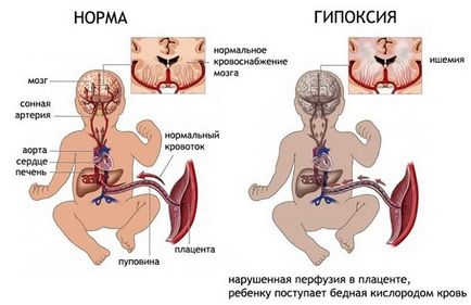 Гідроцефалія головного мозку у дітей до 1 року (новонароджених), водянка після року, симптоми,