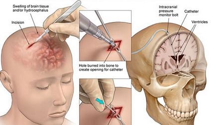 agy Hydrocephalus csecsemők 1 éves (újszülöttek) vízkórosság egy év után, a tünetek,