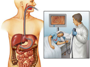 Hypertrophic gastrita - cauze, simptome, tratament, dieta