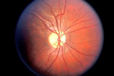 Гліома зорового нерва - лікування, симптоми, діагностика