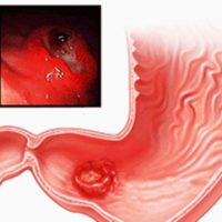 Hormonii pancreasului, funcțiile și consecințele acestora pentru încălcări ale producției de insulină, glucagon,