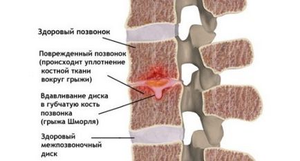 Грижа Шморля - комплекс вправ для лікування