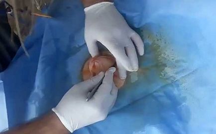 Hernia unui vițel ce să facă, hernie ombilicală în tratamentul vițeilor (foto)