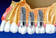 Implantarea implantului de dinți Lugansk, implanturi, implantare dentară, metode moderne