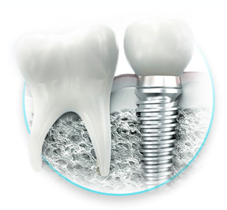 Implantarea implantului de dinți Lugansk, implanturi, implantare dentară, metode moderne