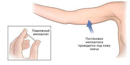 Implantul în mâna contraceptivului pe care trebuie să-l cunoașteți