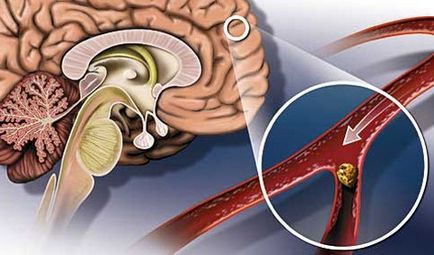 Simptomele creierului cerebral, re-embolizarea și recuperarea după un accident vascular cerebral