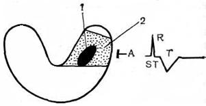 Infarct miocardic intramural - o electrocardiogramă cu infarct miocardic - un ghid pentru