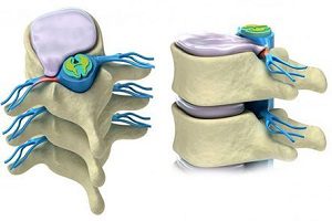 Milyen módon lehet feltölteni vissza gerinc sérv