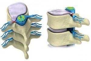 Якими способами можна закачати спину при грижі хребта