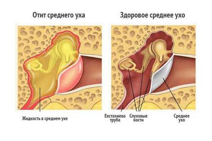 Як лікувати отит в домашніх умовах у дорослих народними засобами, ексудативного, середнього вуха,