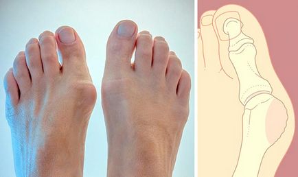 Як лікувати шишку на великому пальці ноги 2 дієвих способу