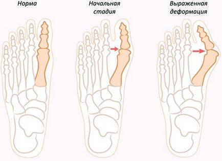 Як лікувати шишку на великому пальці ноги 2 дієвих способу