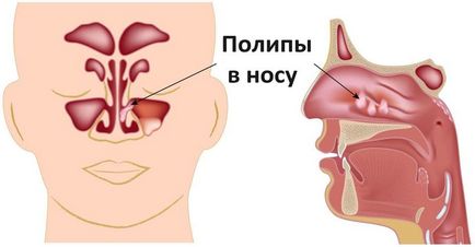 Cum se detectează un polip în nazofaringe și cum este tratat?