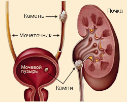 Як очистити нирки - очищаємо із задоволенням!