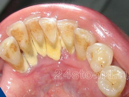 Cum provoacă tartrul aspectul tartrului și relația acestuia cu pierderea dinților, fotografie