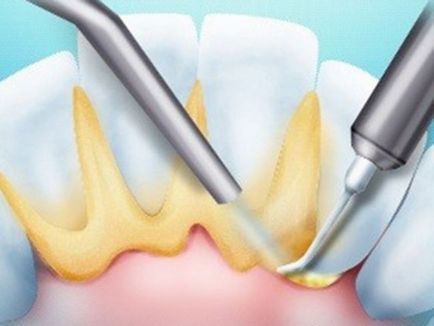Cum provoacă tartrul aspectul tartrului și relația acestuia cu pierderea dinților, fotografie