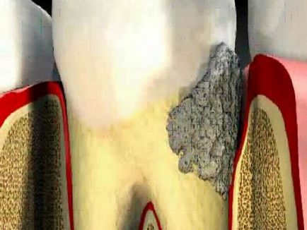 Cum provoacă tartrul aspectul tartrului și relația acestuia cu pierderea dinților, fotografie