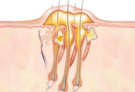 Carbuncle se confruntă cu ceea ce este, simptome și tratament