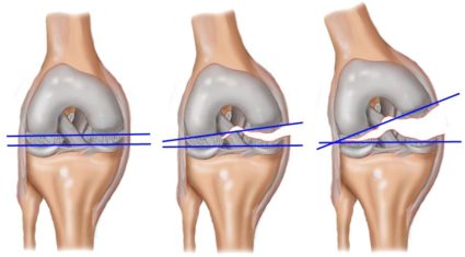 Genunchiul articulației, structura acestuia, dependența de anatomie