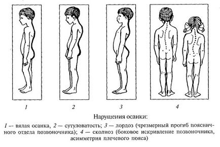 Коректор постави для дітей як вибрати, реклінатор і грудопоперековий