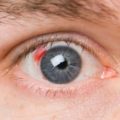 Vérzés a retina (ideghártya) okoz, tünetek és kezelés