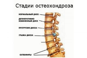 Куріння і остеохондроз