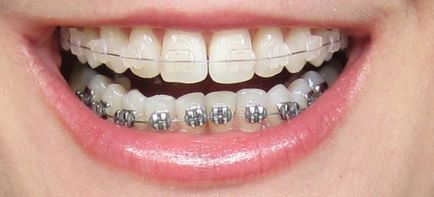 Лазерна стоматологія - вирівнювання зубів