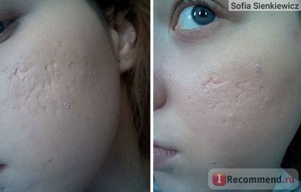 Laser peeling facial - 