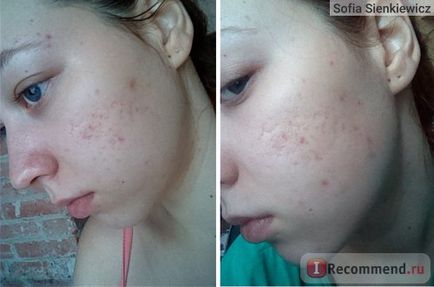 Laser peeling facial - 