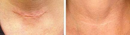 Лазерне видалення шрамів як прибрати шрам лазером на обличчі, тілі