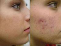 Лазерне видалення шрамів як прибрати шрам лазером на обличчі, тілі