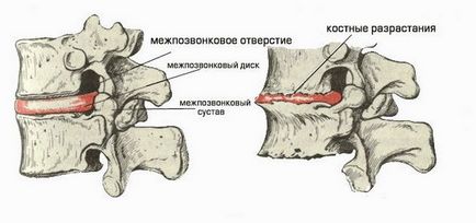 Exerciții terapeutice cu osteocondroză a complexului de exerciții lombare a coloanei vertebrale
