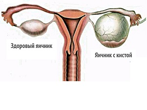 Tratamentul chistului endometrial al ovarului stâng