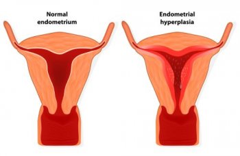 Kezelése endometrium hiperplázia tünetei és okai