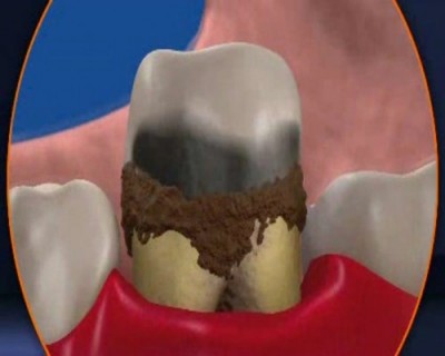 periodontitis kezelést otthon népi jogorvoslati