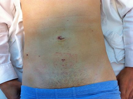 Tratamentul herniei inghinale la Moscova, hernioplastie - preturi, foto-rezultate