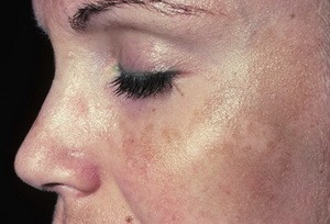 A kezelés a pigmentált foltok az arcon