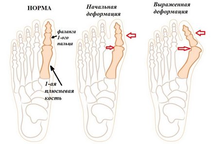 Tratamentul conurilor pe picioare, centrul traumatologiei și ortopediei