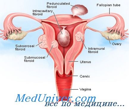 Sângerarea uterină pentru neoplasmele uterine