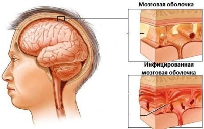 Tipurile de infecție cu meningită, cauze, simptome