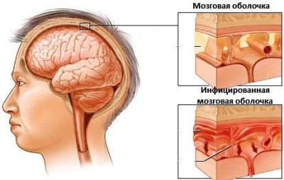 Менінгітового інфекція види, причини, симптоми