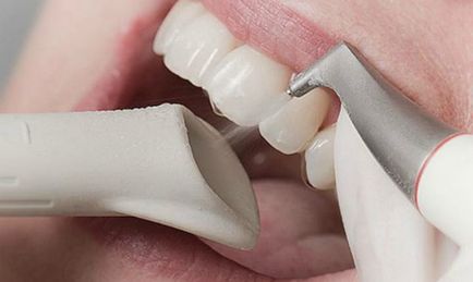 A kezelési módszerek a fogszuvasodás nélkül fúró ózon, a levegő, a fluoreszcencia