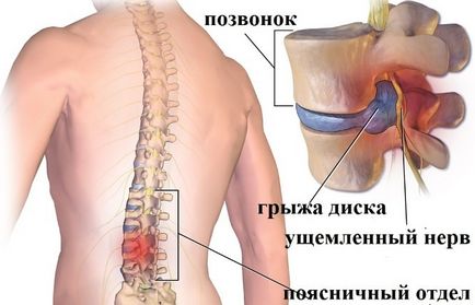Fie că este posibil alcool la o hernie vertebrală și inghinală, operații