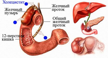 Народне лікування жовчного міхура