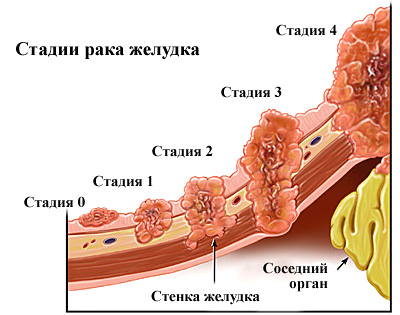 Недиференційований рак шлунка - що це таке