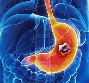 Cancerul de stomac nediferențiat - ce este?