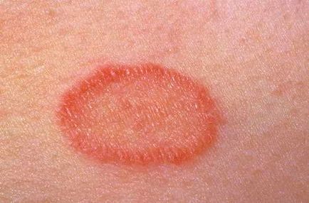 Az atópiás dermatitis - tünetek és kezelés, fotók, hogyan kell kezelni a neurodermitis